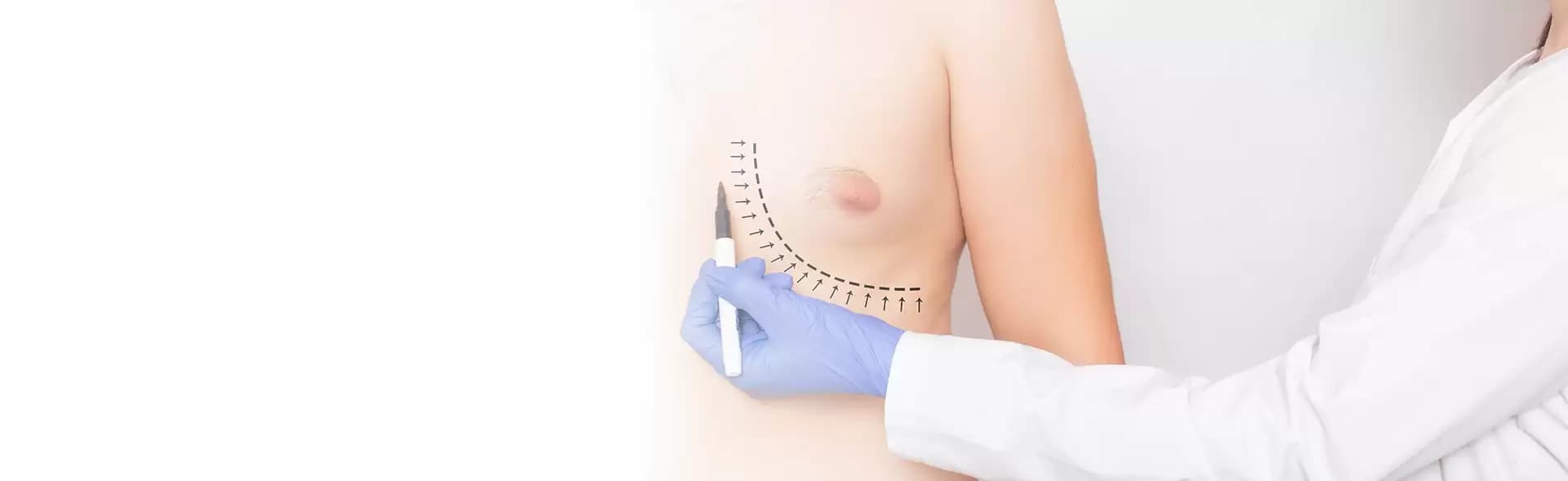 Gynecomastia