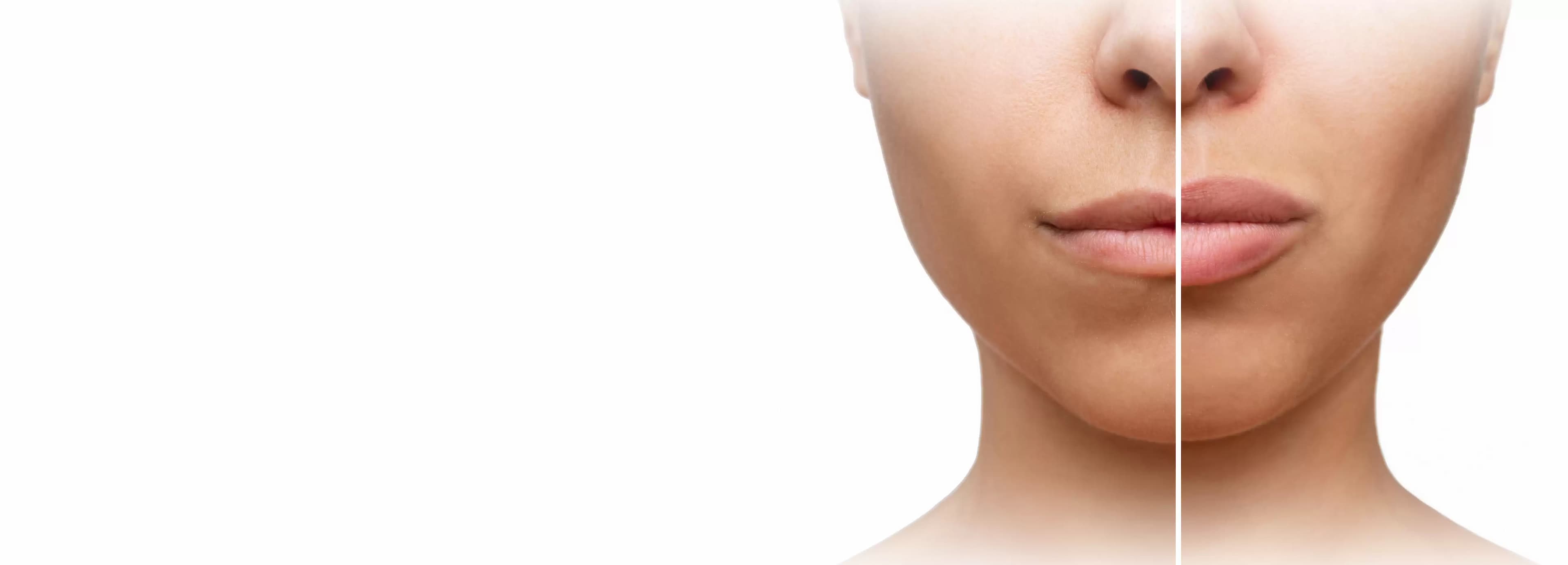 Buccal Fat Removal Surgery