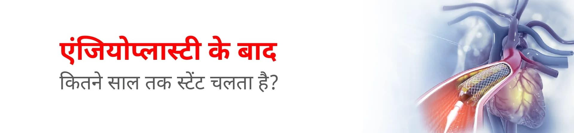 एंजियोप्लास्टी के बाद कितने साल तक स्टेंट चलता है?