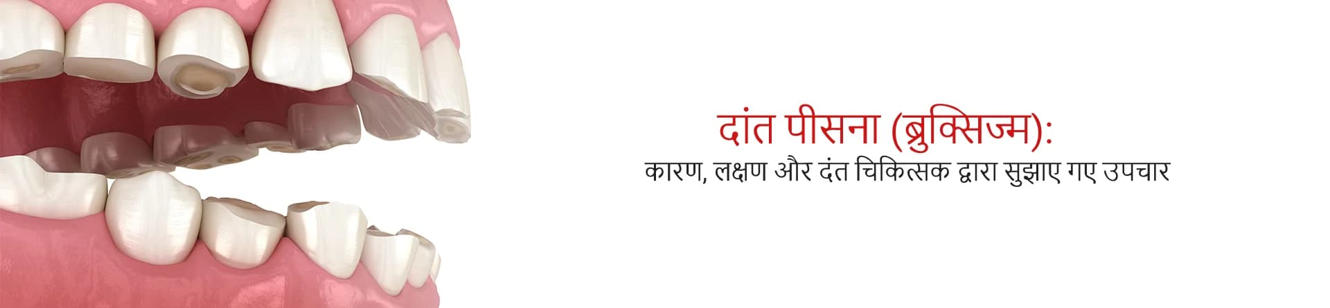 दांत पीसना (ब्रुक्सिज्म): कारण, लक्षण और दंत चिकित्सक द्वारा सुझाए गए उपचार