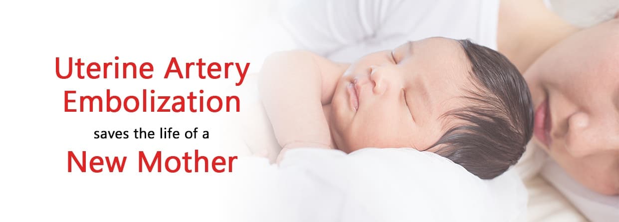Uterine Artery Embolization saves the life of a new mother