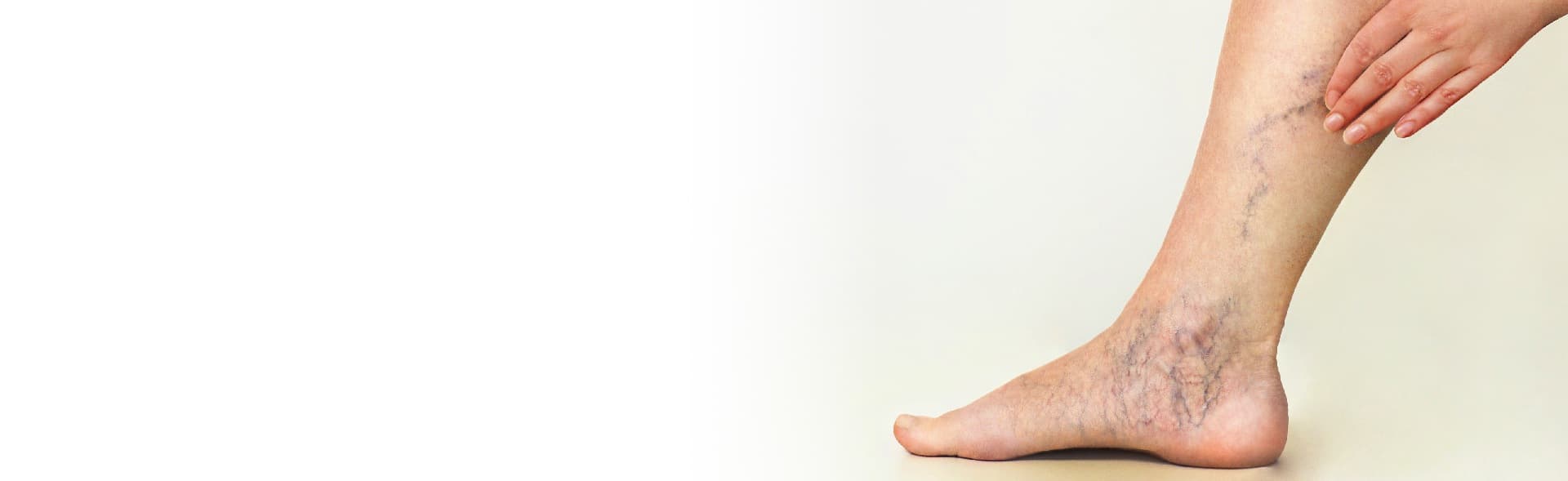 Deep vein thrombosis