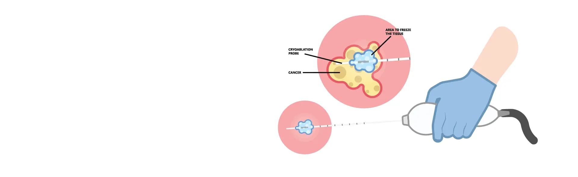 Cryoablation