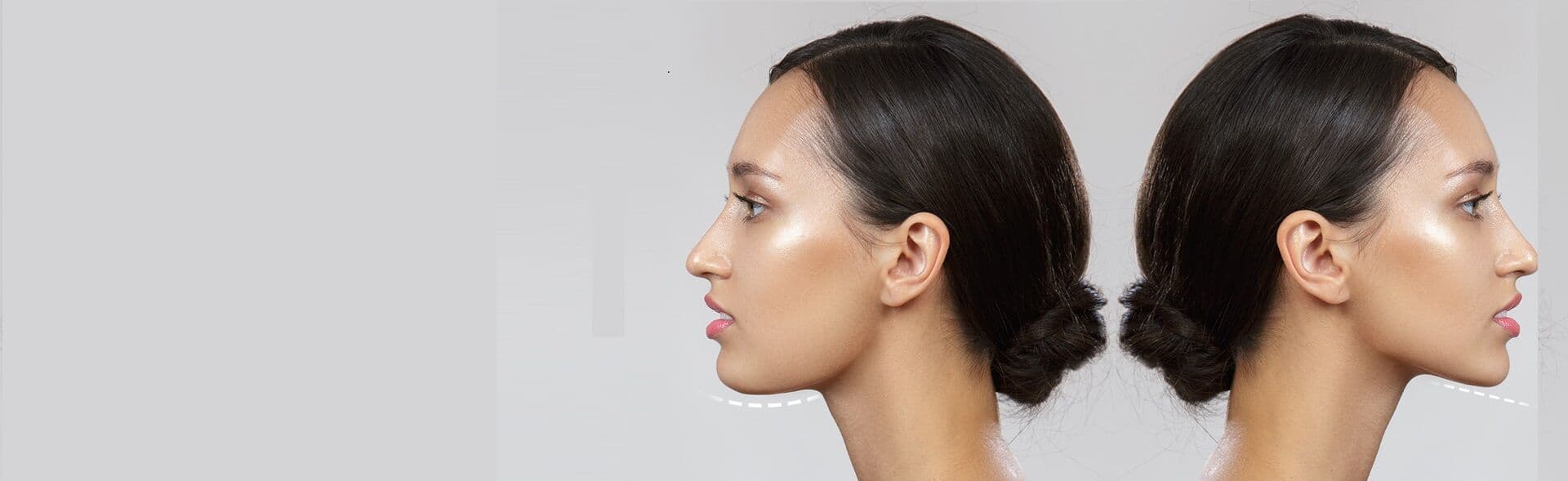 Corrective Jaw Surgery