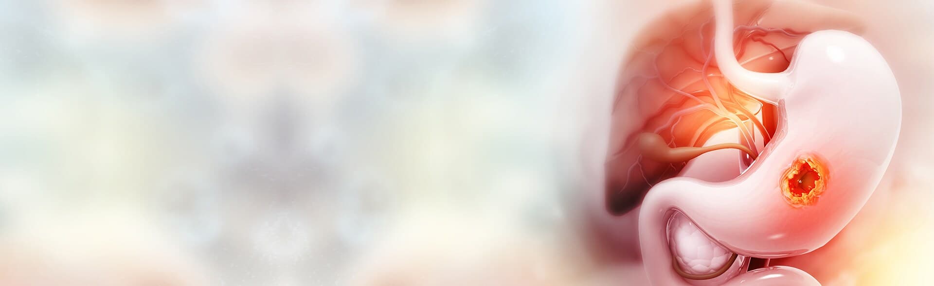 Gastric Banding