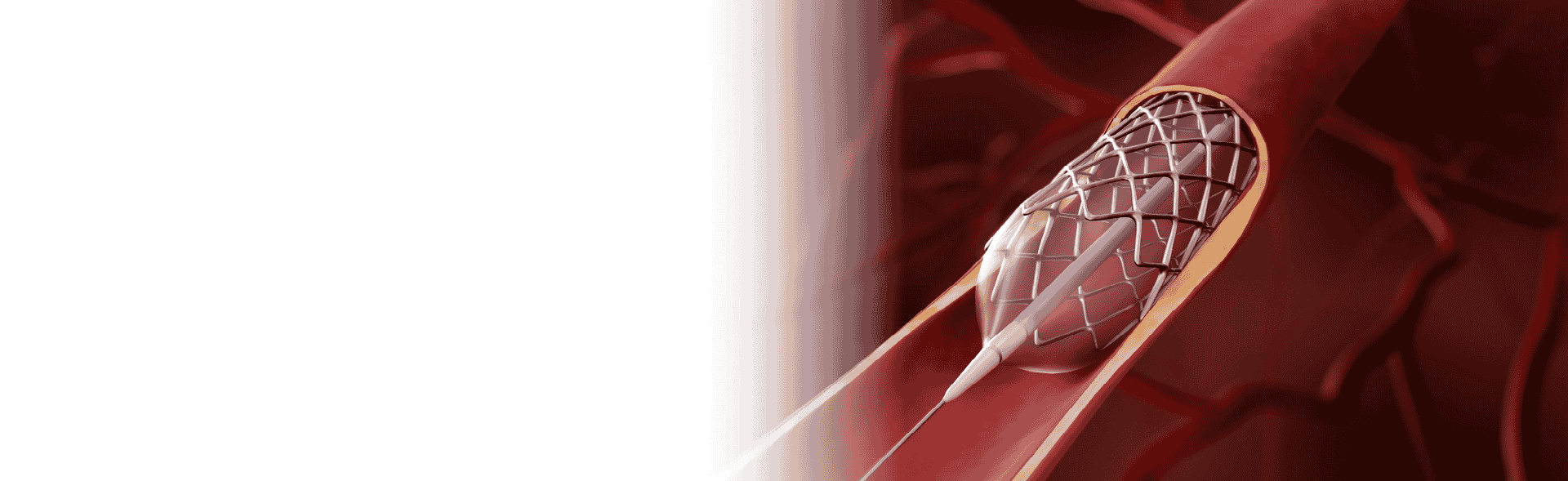 Stenting